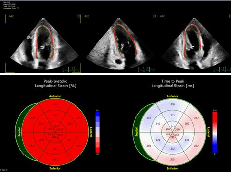 global peak longitudinal strain echo